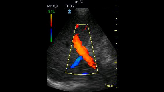 hotspot tours-vscan-liver portal vein and artery with color flow 2457_jpg
