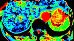 Ct Perfusion 4D Multi-Organs para visualización avanzada.