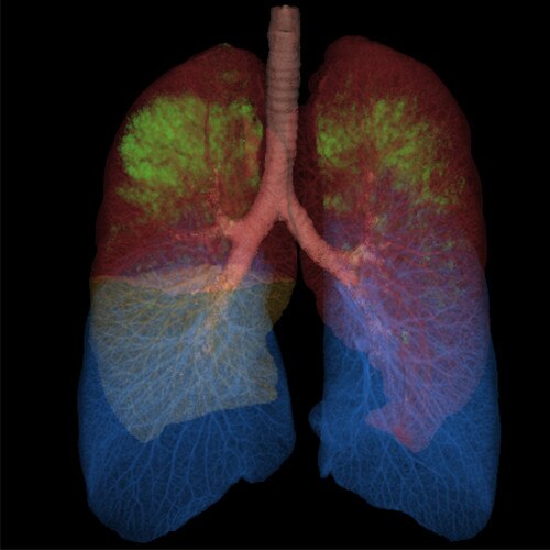 pulmones con thoracic vcar.