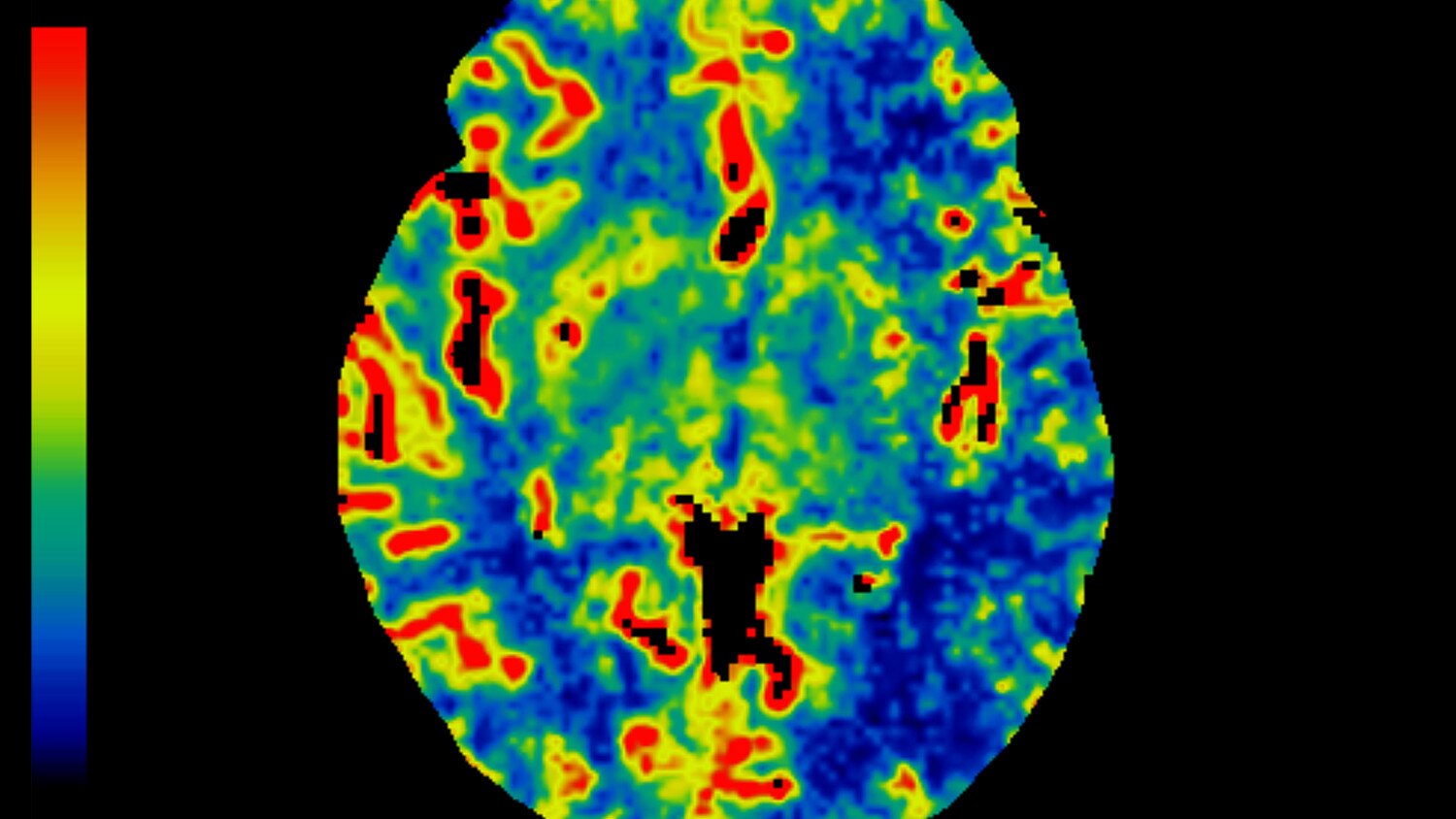 ct perfusion 4d para visualización avanzada.
